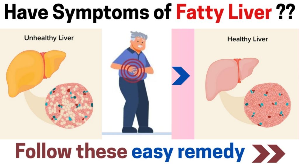 Current image: Fatty Liver Disease: Forms, Symptoms, Diagnosis & Treatment